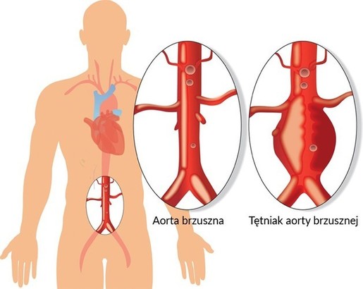 Ilustracja do artykułu: Bezpłatne badania USG aorty brzusznej dla mężczyzn