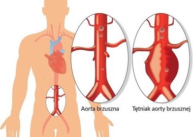 Ilustracja do artykułu: Bezpłatne badania USG aorty brzusznej dla mężczyzn